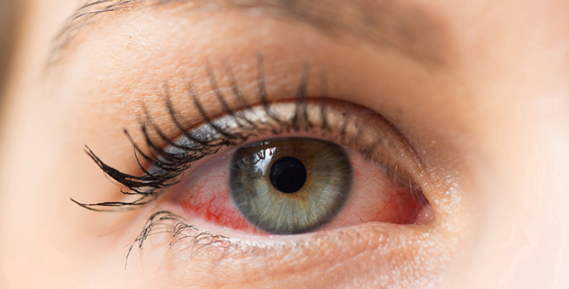 Effective Home Remedies for Red Eyes